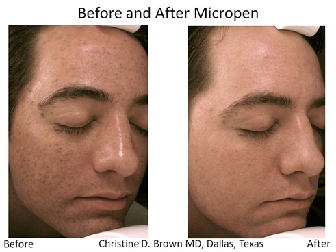 Eclipse Micropen Acne Scar Treatment Dallas