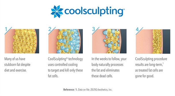 How Cool Sculpting Works