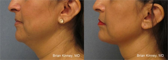 Before and After ThermiTight Skin Tightening Laser Dallas