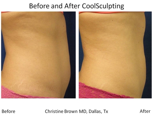 Coolsculpting Dallas Before and After