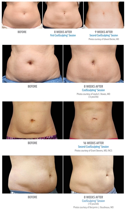 beforeAfter Collage