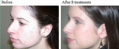 before and after IPL fotofacial 1