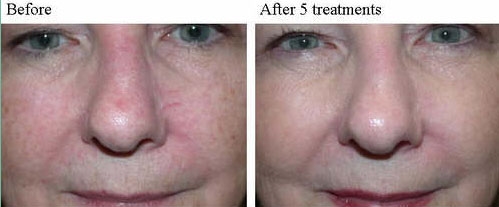 before and after IPL fotofacial 2