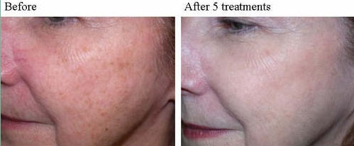 before and after IPL fotofacial 3