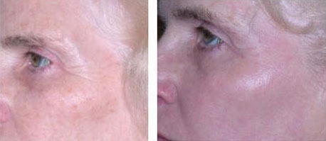 before and after c02
