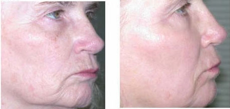 before and after c02 2
