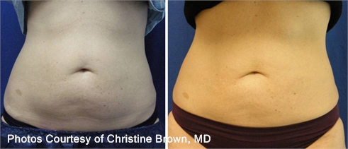 coolsculpt1