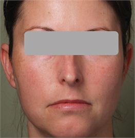 photofractional before