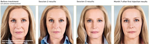 Sculptra Before to After Photos Sculptra Before to After Photos