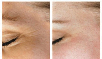 before and after microdermabrasion