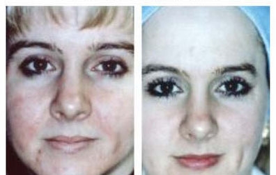 before and after microdermabrasion 2